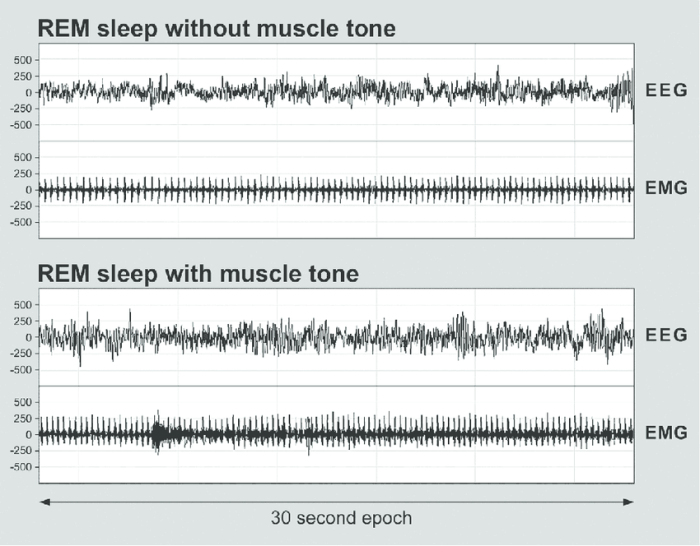 Eeg neurology basics pediatric