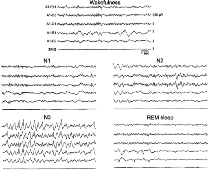 A flat eeg is a good indication of deep sleep